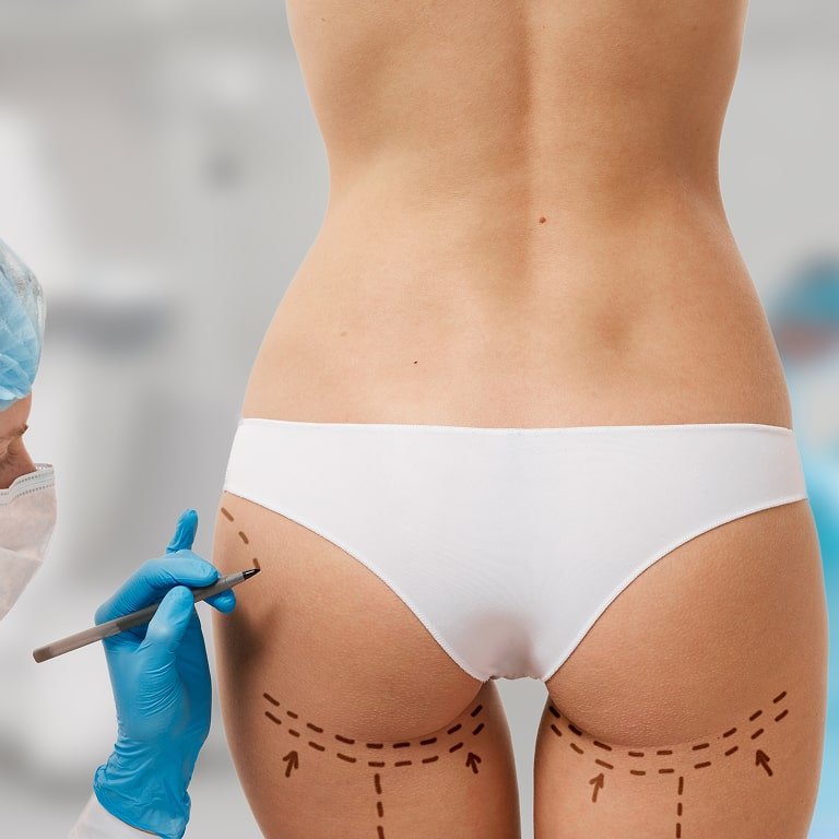 woman-marked-out-cosmetic-surgery (1)-min